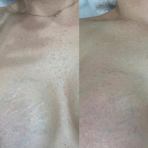 Удаление растяжек лазером на груди Lumenis M22