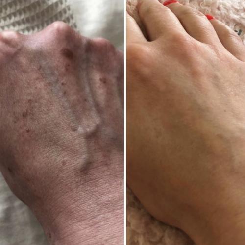 Лазерное удаление пигментации на руках