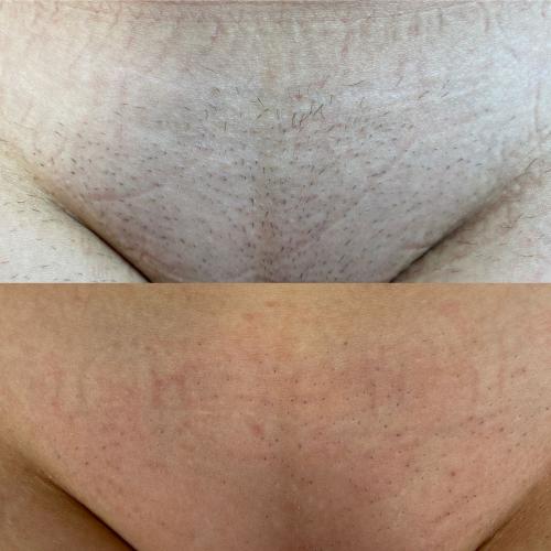 Результат после 3 сеансов лазерной эпиляции Lumenis Desire