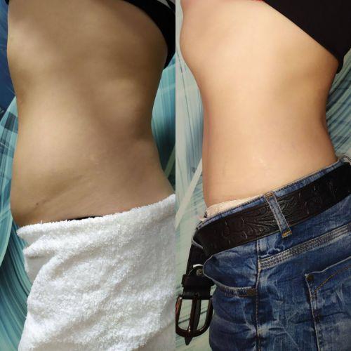 Зона живот через 19 дней после криолиполиза