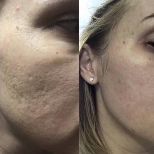 Результат лазерная шлифовка кожи Lumenis M22