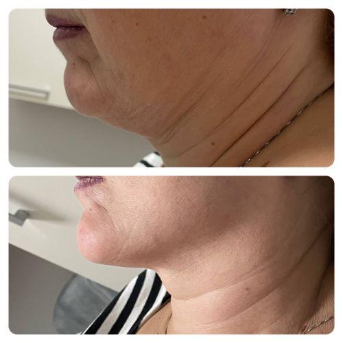 Зона подбородок через 30 дней после криолиполиза