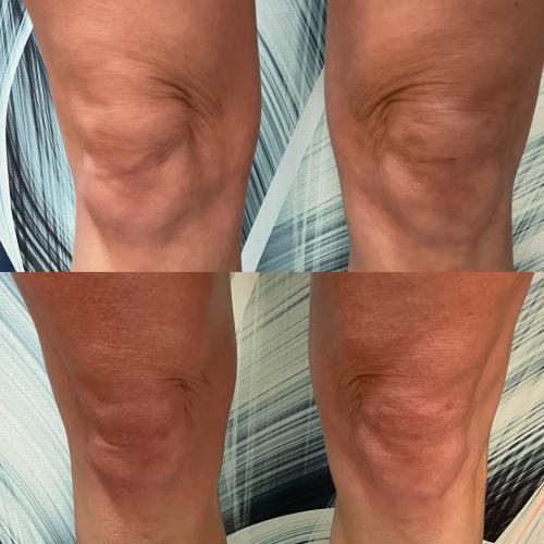 Подтяжка коленей сразу после процедуры INDIBA