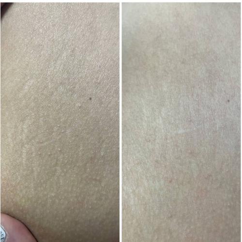 Результат удаления растяжек лазером на платформе Lumenis M22