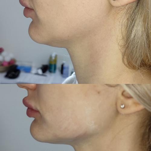 SMAS лифтинг лица