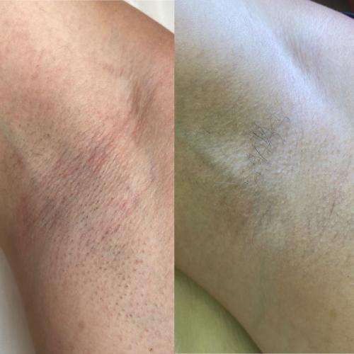 Результат после 3 сеансов лазерной эпиляции Lumenis Desire