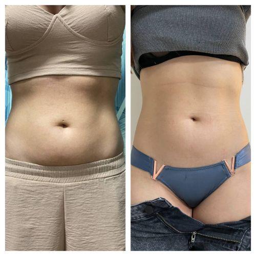 Зона живот через 35 дней после криолиполиза
