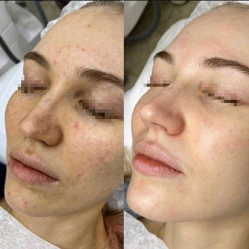 Фотоомоложение лица (термолифтинг) Lumenis M22