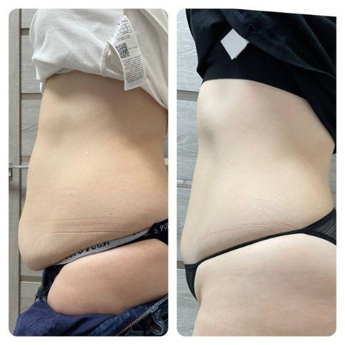 Зона живот через 47 дней после криолиполиза