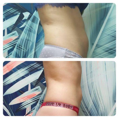   Зона живот-бока через 36 дней после криолиполиза