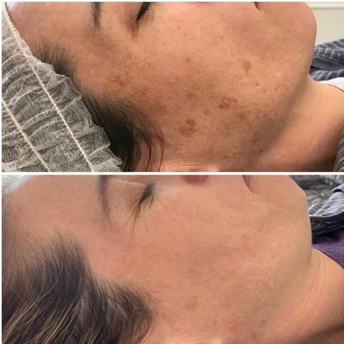 Лазерное удаление пигментации на лице