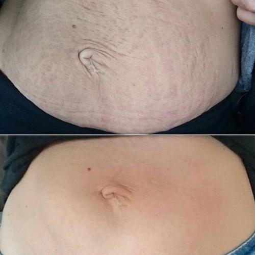 Результат удаления растяжек лазером Lumenis M22 на животе 