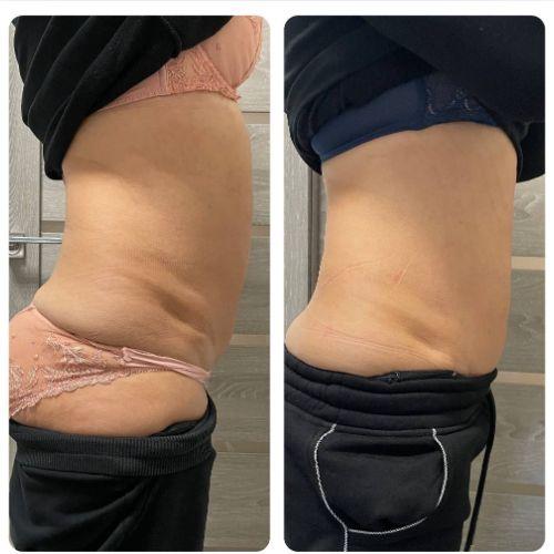 Зона бока через 30 дней после криолиполиза
