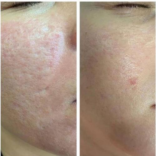 Лазерная шлифовка кожи постакне