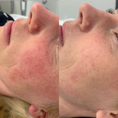 Удаление сосудов на щеках лазером Lumenis M22