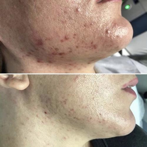 Лазерное лечение акне Lumenis M22