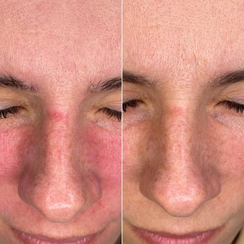 Чистка лица Indiba Ona