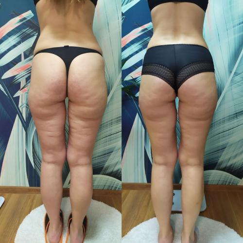 Результат после Endospheres Therapy