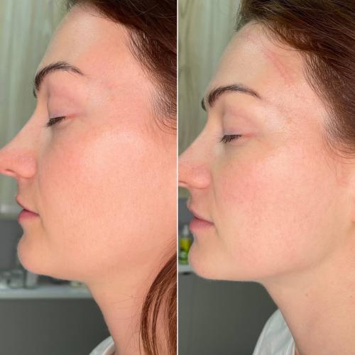 SMAS лифтинг лица