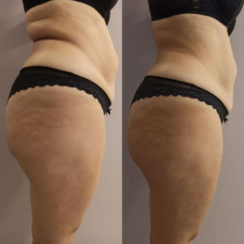 Результат после Endospheres Therapy